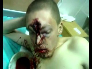 Неудачный суицид Неудачный суицид