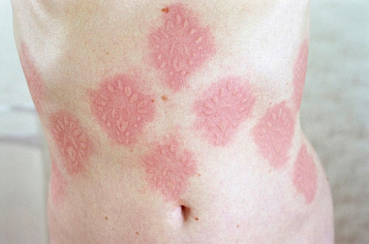 Artist Creates Body Designs with Her Sensitive Skin Disorder