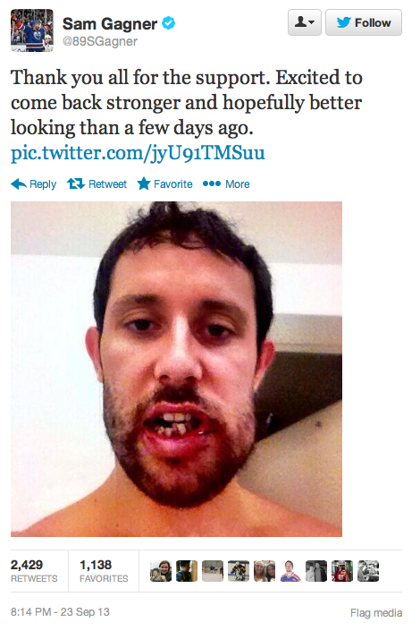 A Stick To The Face Turned Edmonton Oiler Sam Gagner Into A Monster